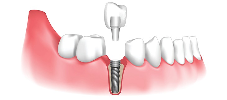 Dental Implant Care